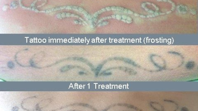 Avoid Tattoo Removal Through The Perfect Tattoo!