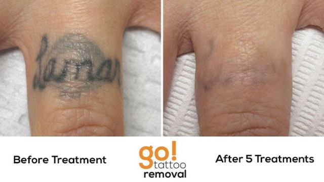 Laser Tattoo Removal Cost – Does It Come With Worth This Tool?