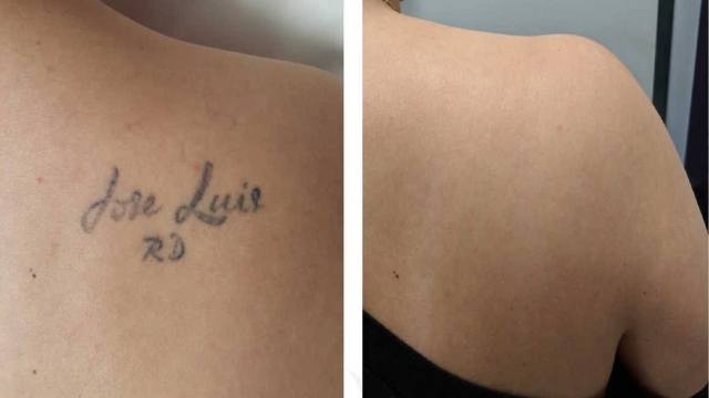 Tattoo Removers – What Is The Safest Tattoo Removal Service?
