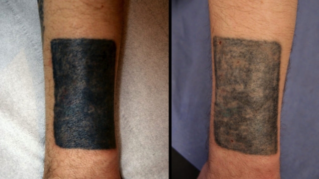 Tattoo Removal Cream Alternative – Is Tca Tat Removal Risk-Free?