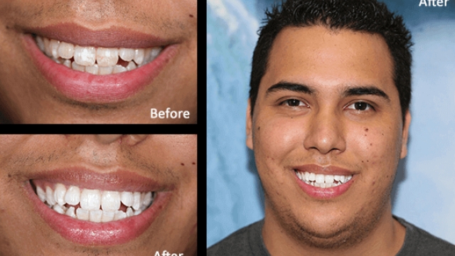 Smile Brighter: Unleashing the Magic of Teeth Whitening