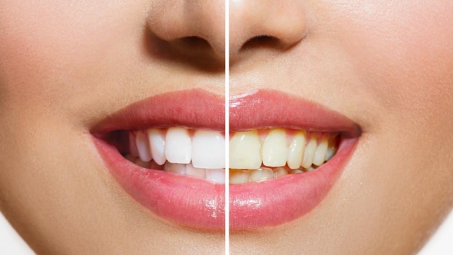 Sparkling Smiles: Unveiling the Best Teeth Whitening Products