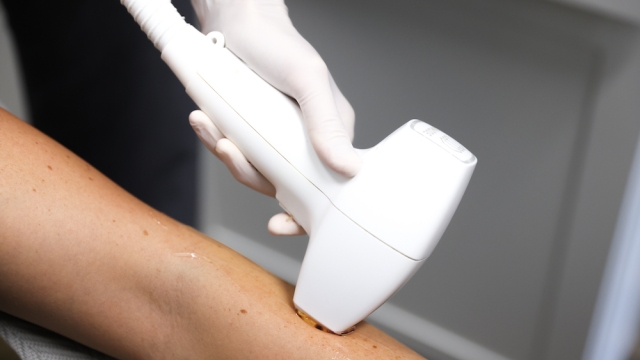 Smooth and Hair-Free: Unleashing the Magic of Laser Hair Removal